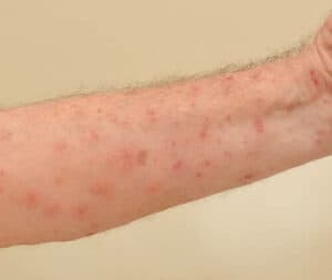 Tecnico in tuta protettiva che esegue la disinfestazione delle fognature per prevenire la presenza di acari e altri insetti che possono causare allergie
